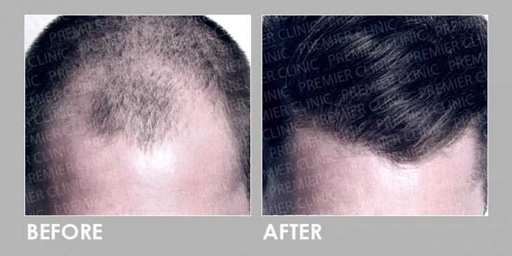 FUE Hair Transplant Before & After