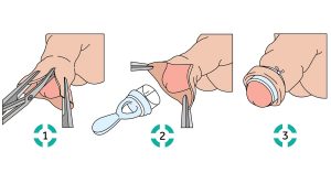 Plastibell Circumcision 