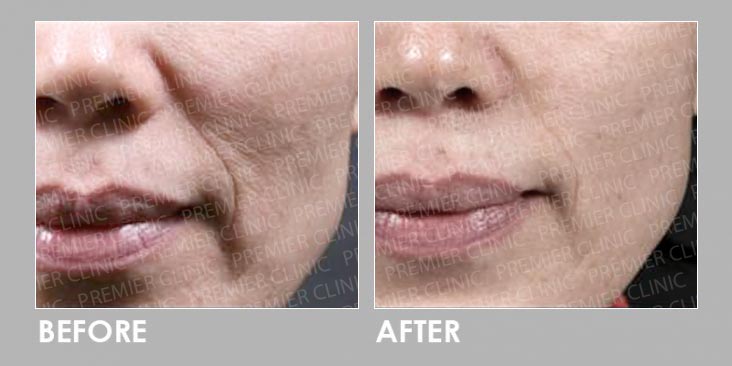 Before & After Potenza RF Micro-needling