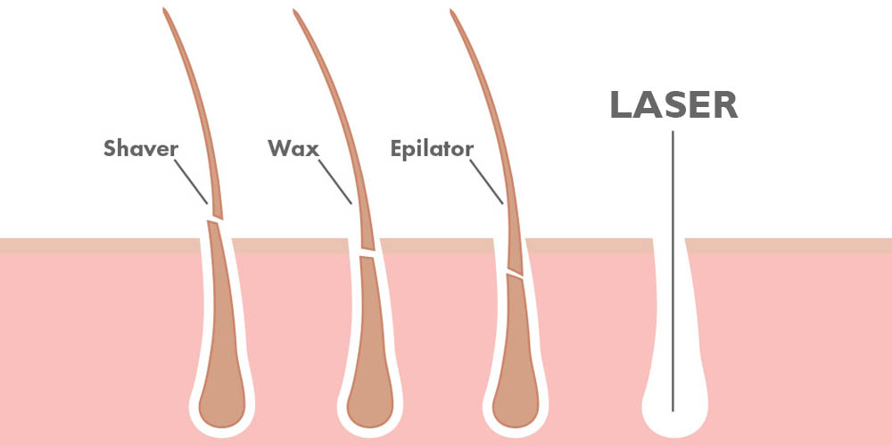 Brazilian hair outlet laser