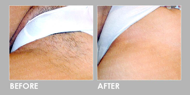 Laser Hair Removal in Ithaca, NY | Ferrer & Monaghan