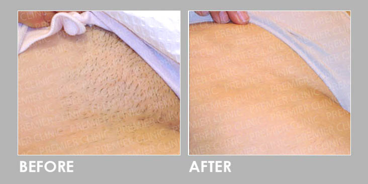 Brazilian Laser Hair Removal Before After