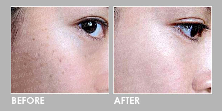 Spotless Skin Solution Before & After