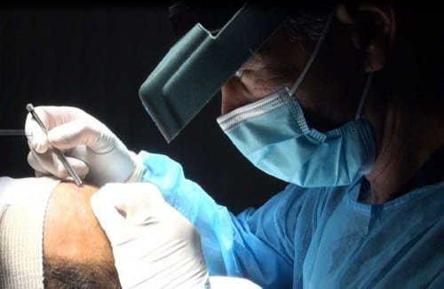ABOUT FUE HAIR TRANSPLANT