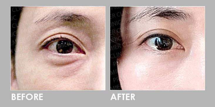 PuffyEye Relieve Before & After