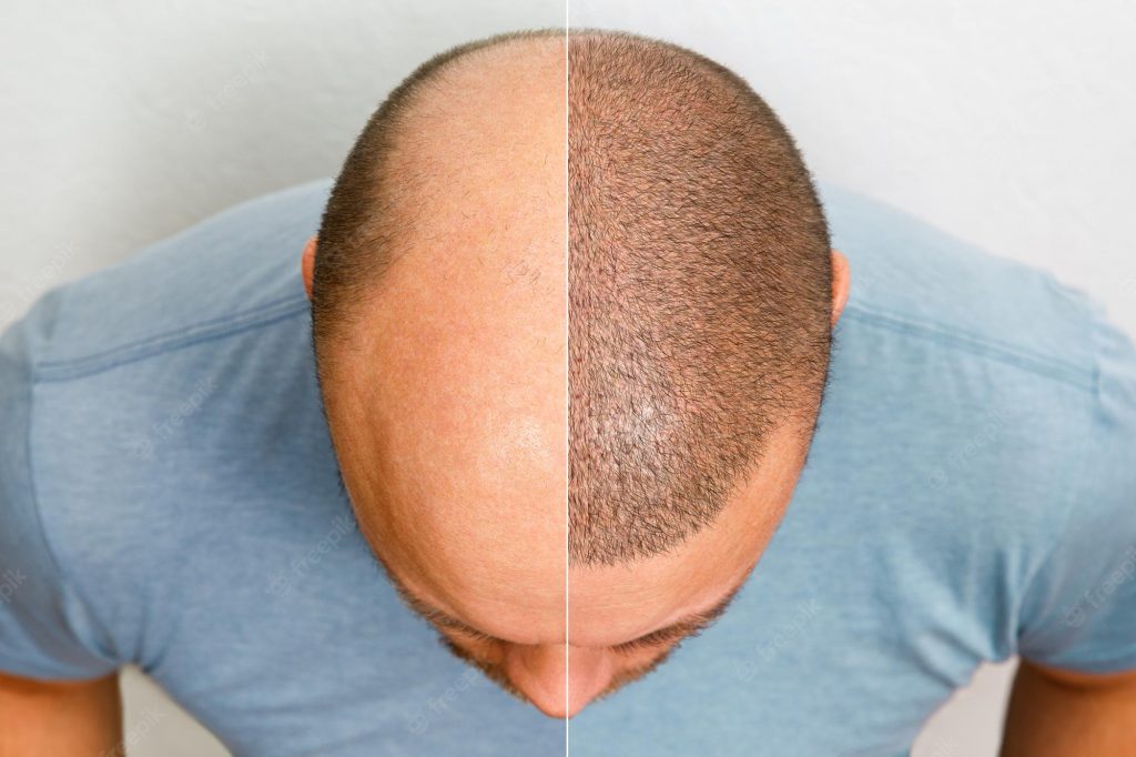 A permanent hairline with natural-looking results