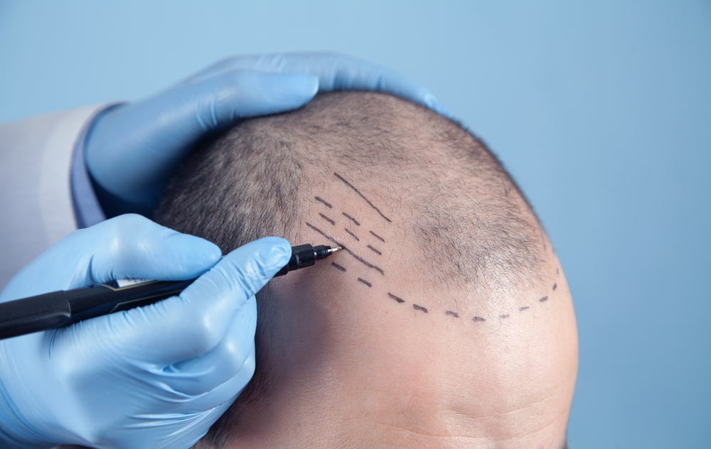 ABOUT FUE HAIR TRANSPLANT