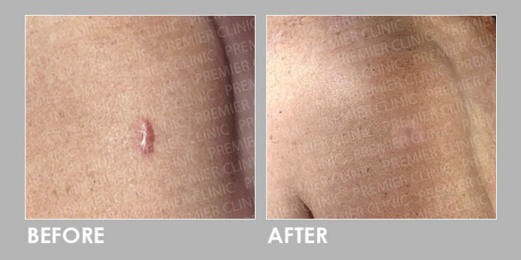 KELOID FREEZING THERAPY Before & After