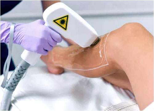 DIODE LASER FOR HAIR REMOVAL