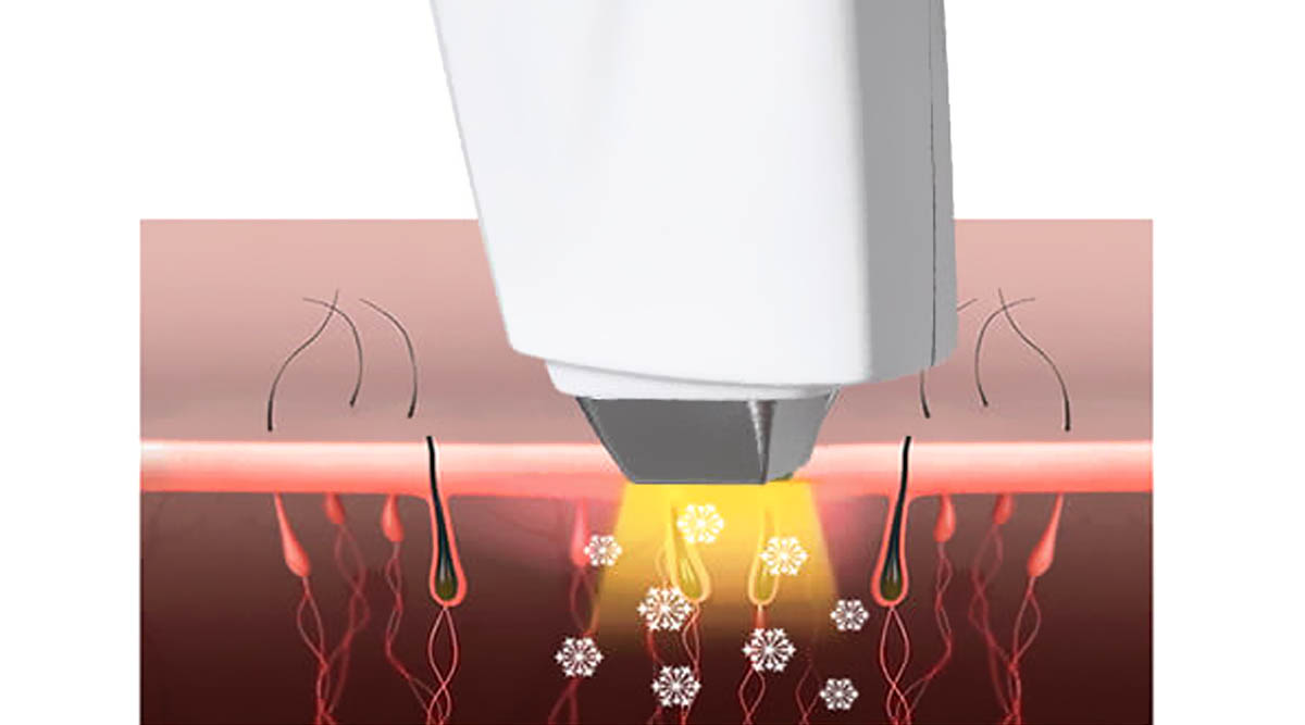 DIODE LASER FOR HAIR REMOVAL