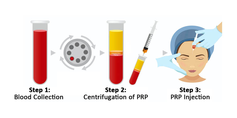 Face PRP Injection 