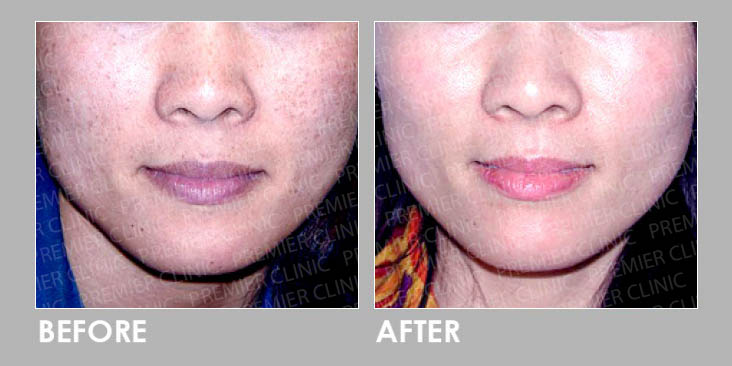 Best Skin Boosters Profhilo & Gouri Promo before and after 02