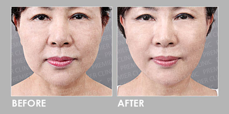 Ultherapy Potenza Skin Lift Promo before and after