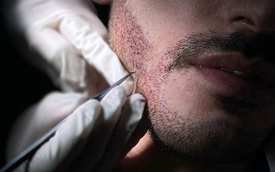 FUE Beard Hair Transplant - Implantation of Hair Follicles