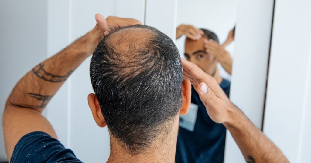 PREVENT HAIR LOSS