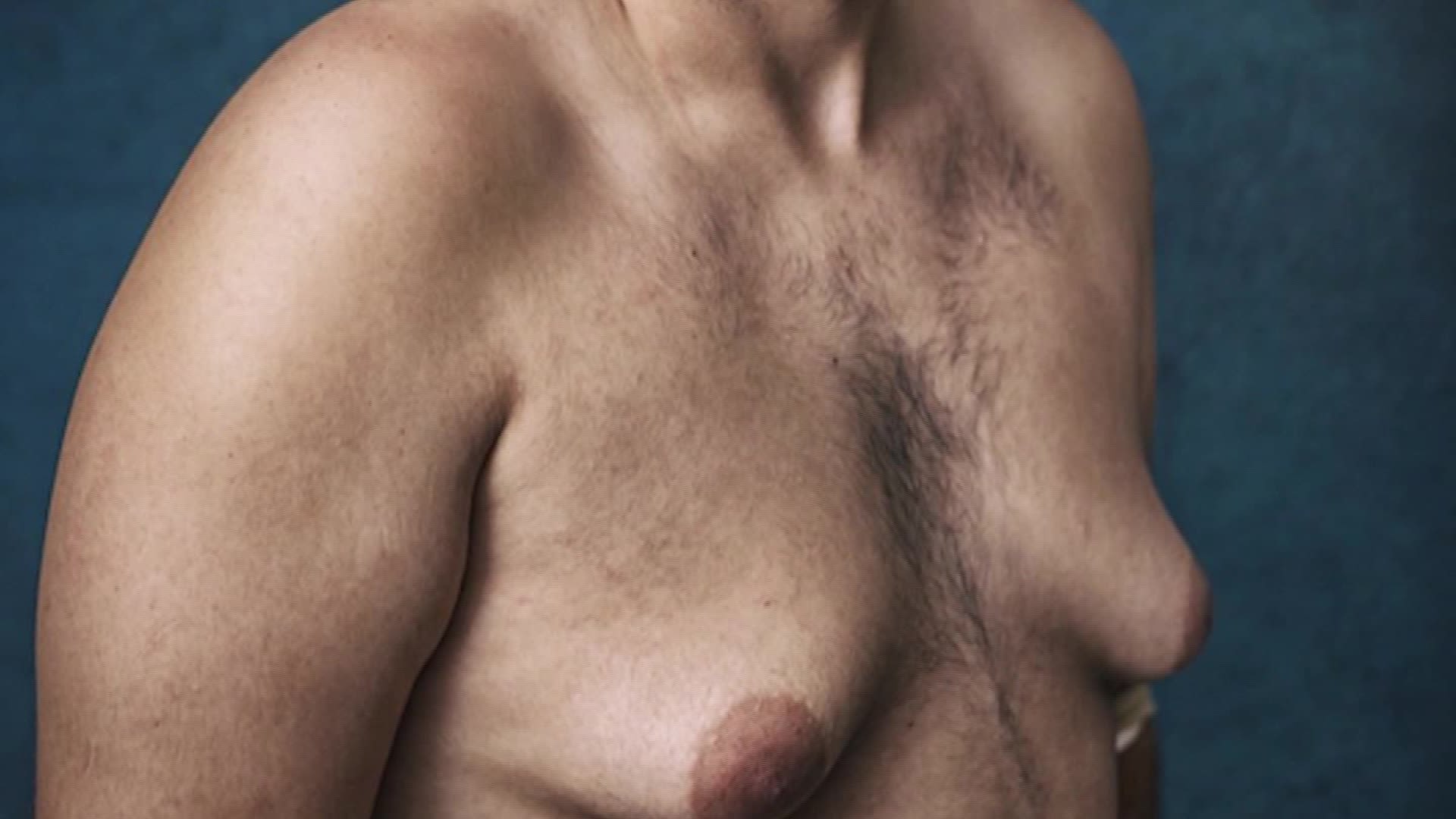 опухоль в районе груди у мужчин фото 91
