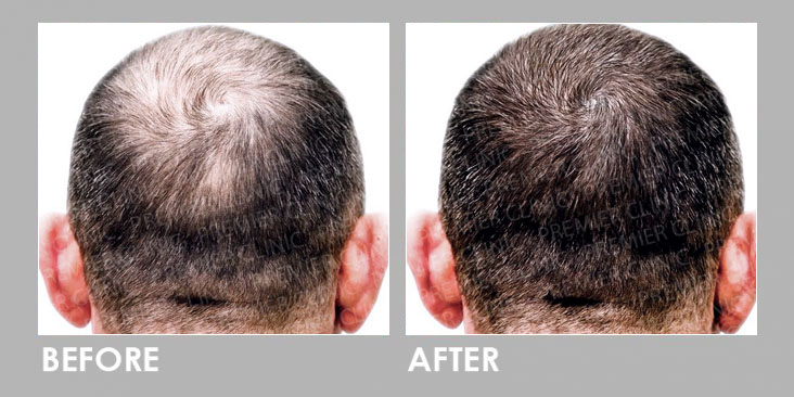 EXOSOME HAIR LOSS THERAPY BEFORE & AFTER
