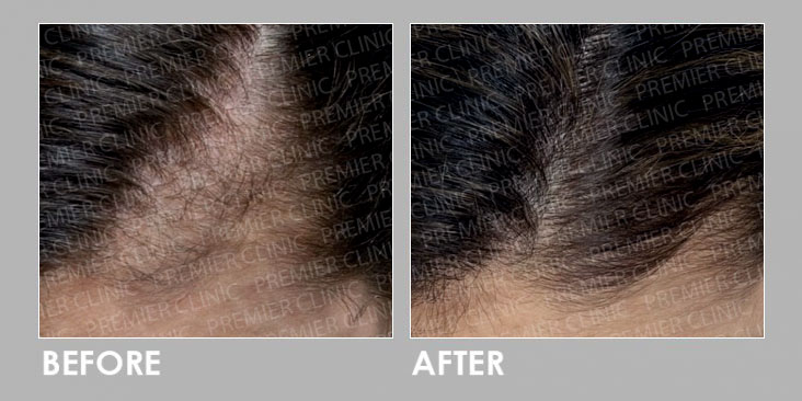 EXOSOME HAIR LOSS THERAPY BEFORE & AFTER