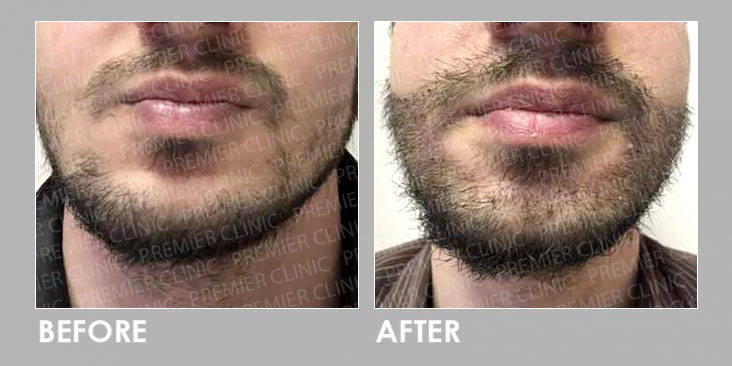 FUE BEARD TRANSPLANT before & after