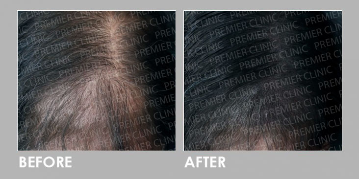 Hair Follicles Enhancer (Scalp Micropigmentation) before & after