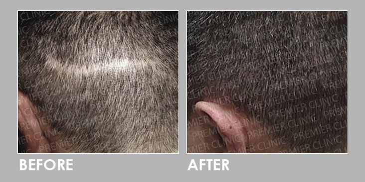 Hair Follicles Enhancer (Scalp Micropigmentation) before & after