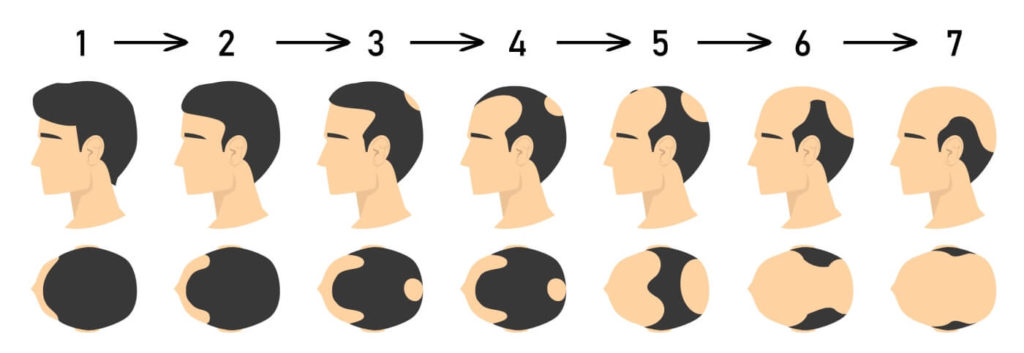 POSSIBLE CAUSES OF HAIR LOSS IN MALE