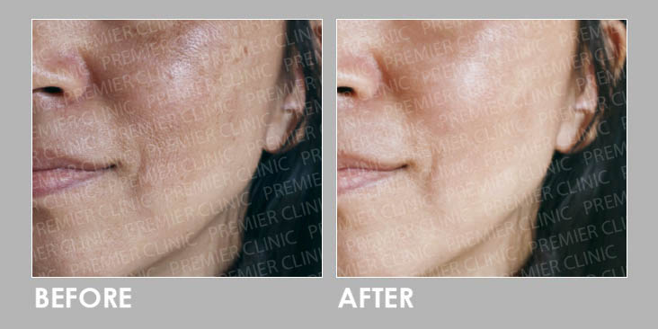 Raya quick skin preps before & after