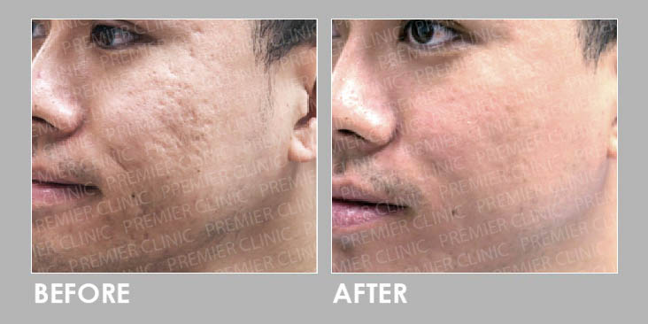 Raya quick skin preps before & after