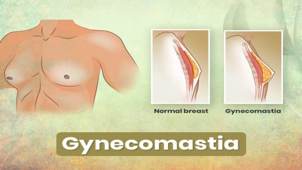 SYMPTOMS OF GYNECOMASTIA