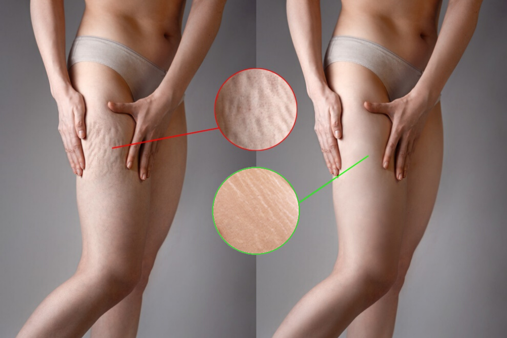 STRETCH MARKS AND CELLULITE