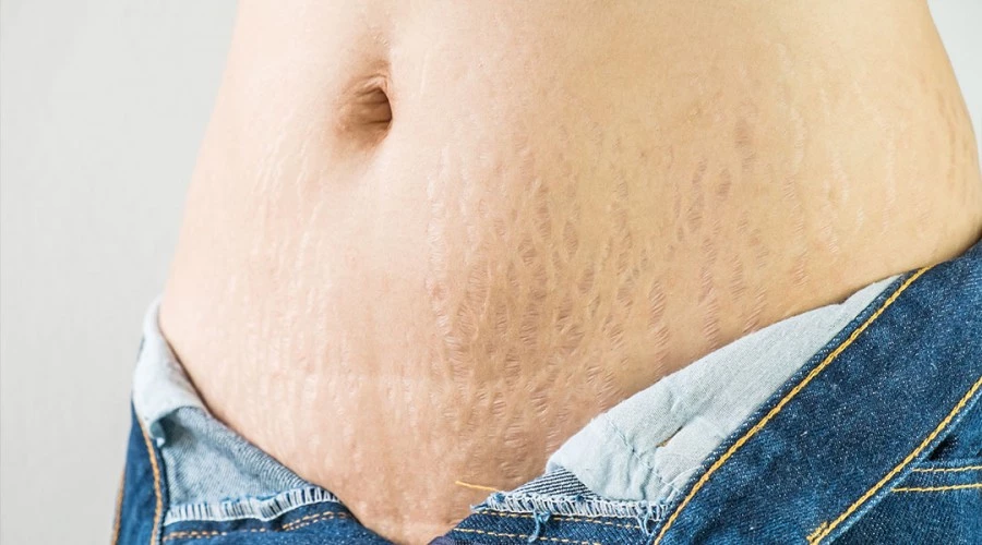 How-to-Get-Rid-of-Cellulite-and-Stretch-Marks