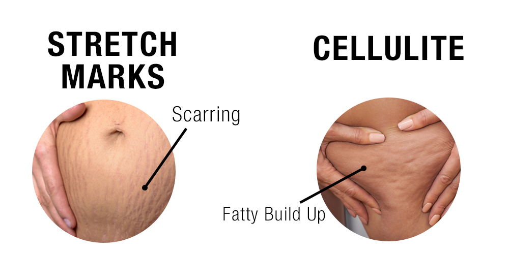 How-to-Get-Rid-of-Cellulite-and-Stretch-Marks