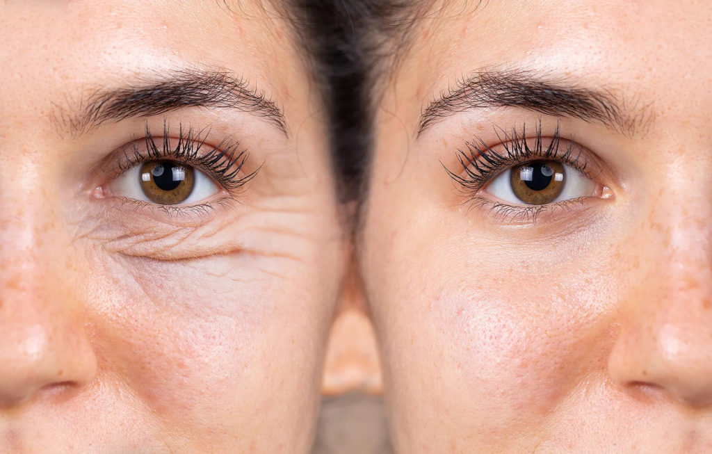 10 Common Myths About Botox