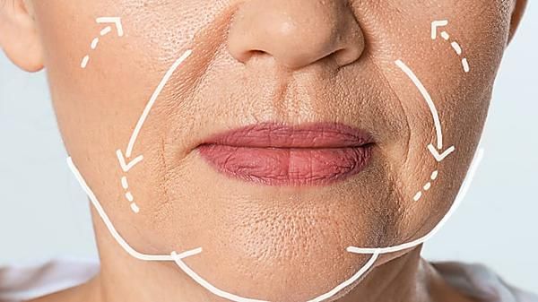 WHAT ARE SAGGING JOWLS?