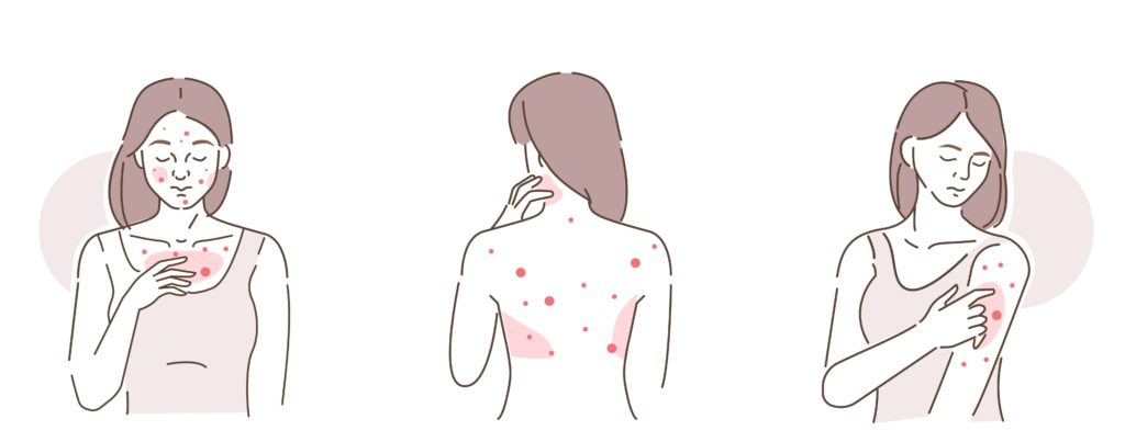 6 DIFFERENT TYPES OF BACK ACNE