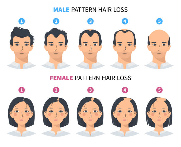 Male-pattern hair loss & Female-pattern hair loss