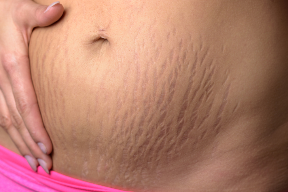 Stretch Marks And Cellulite
