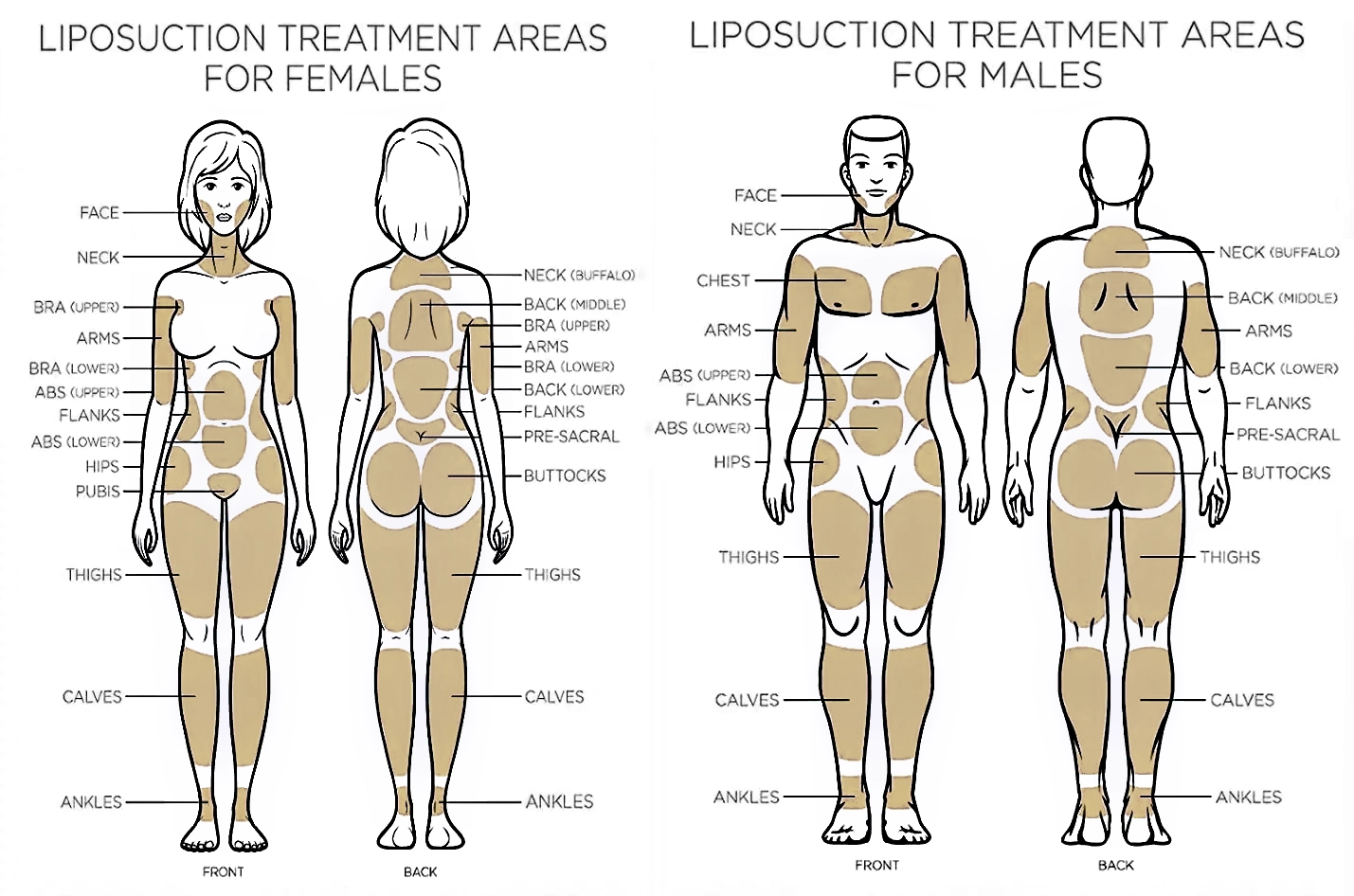 Liposuction 