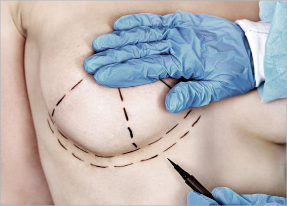 Breast Implant Surgery