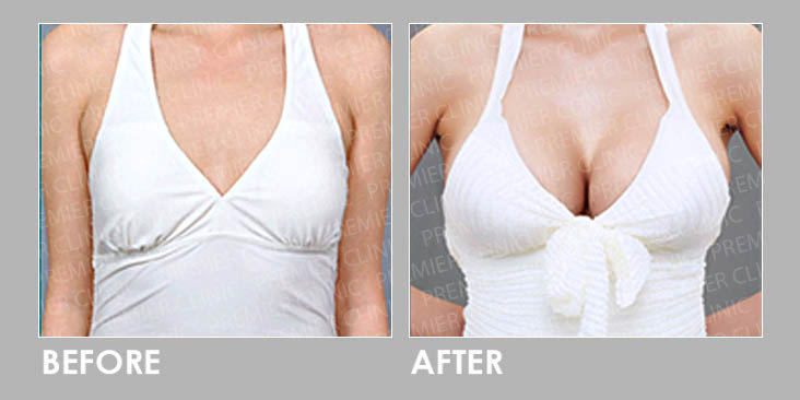 Breast Implant Surgery Before & After