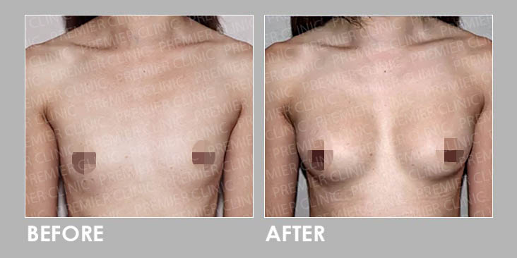Breast Implant Surgery Before & After