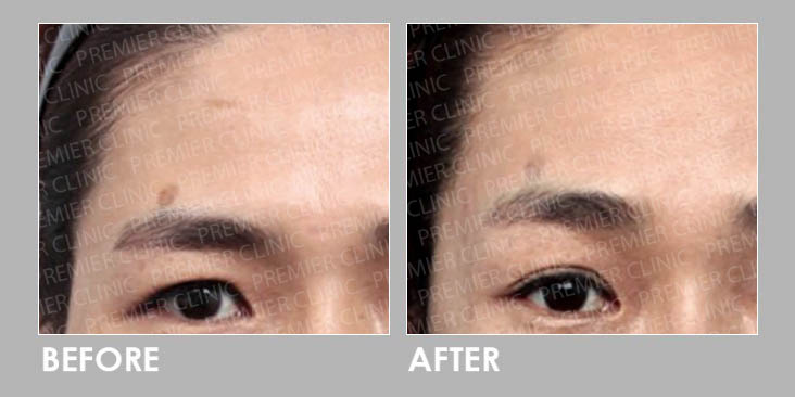 Brow Lift Surgery Before & After