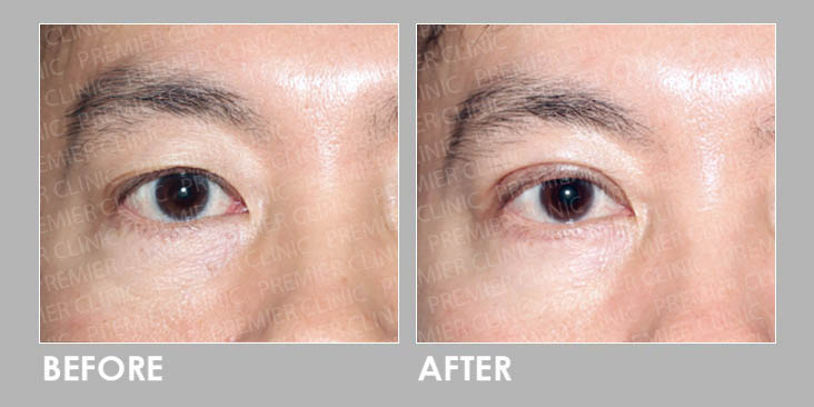 Brow Lift Surgery Before & After