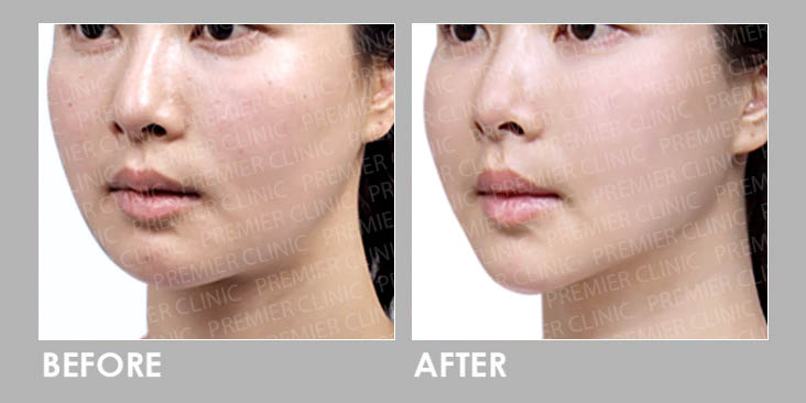 Buccal Fat Removal Surgery Before & After