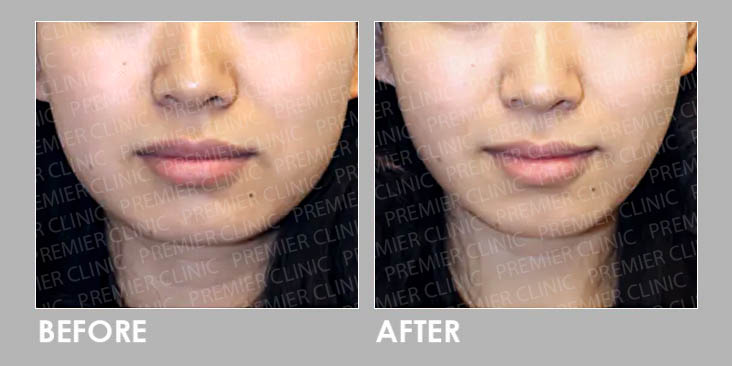 Buccal Fat Removal Surgery Before & After