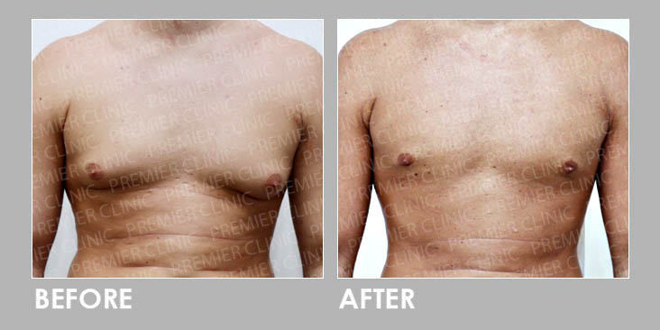 Gynecomastia Surgery Before & After