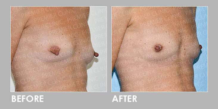 Nipple Reduction Before & After