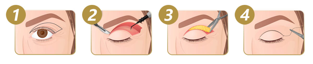 Upper Blepharoplasty