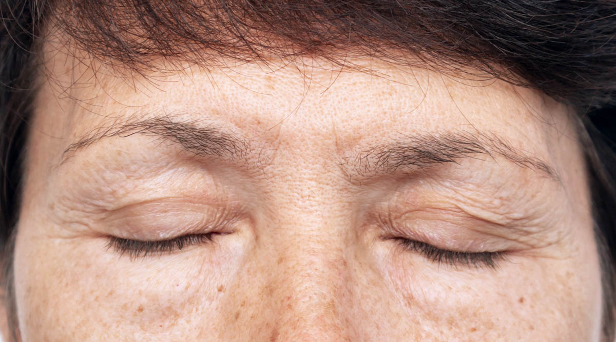 What Can I Do About My Droopy Eyelids
