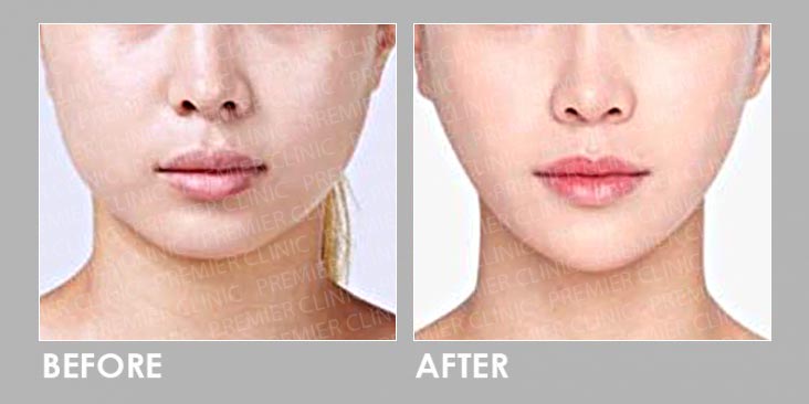 JAW BOTOX BEFORE AND AFTER